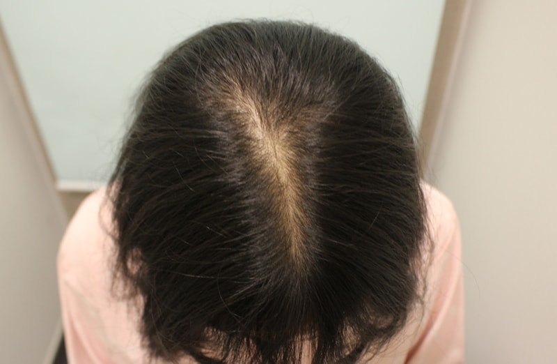 女性头顶苦恼，毛发移植240天