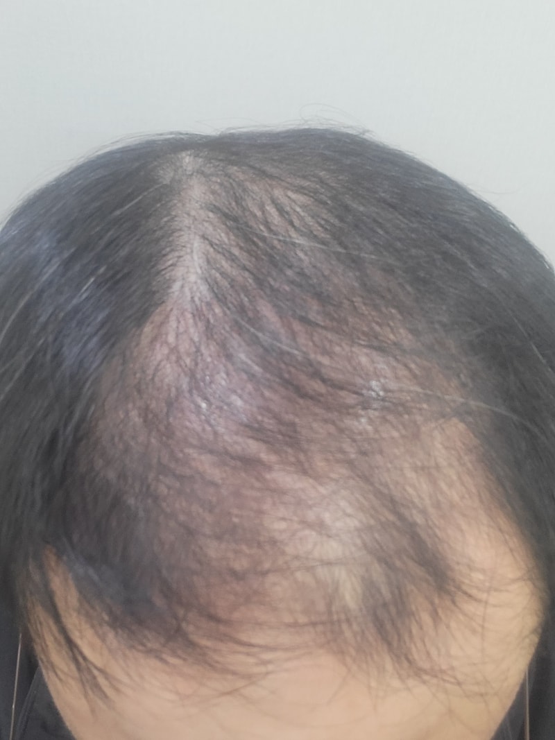 다나 비절개 17개월 후기입니다