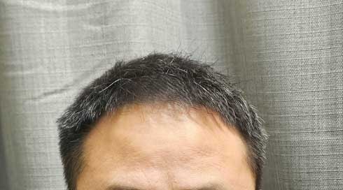 모발이식23.jpg