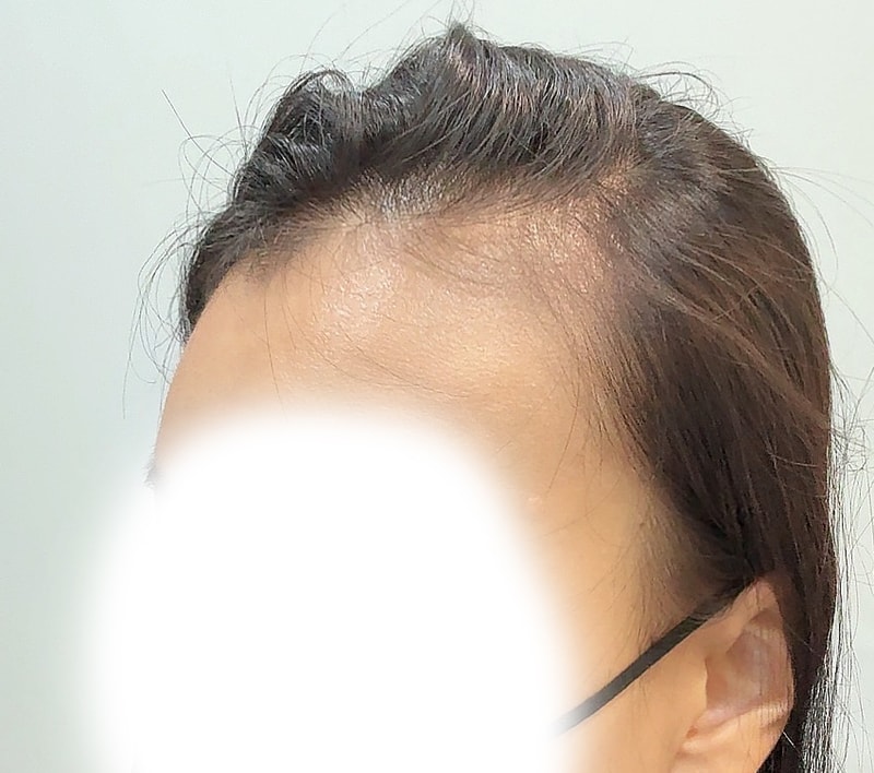 얇은 모발 여성의 2200모낭 모발이식 3일차 후기