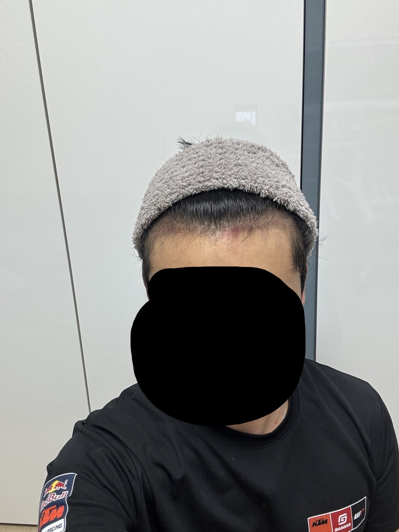 다나 헤어라인 수술 2개월 후기 암흑기 시작.