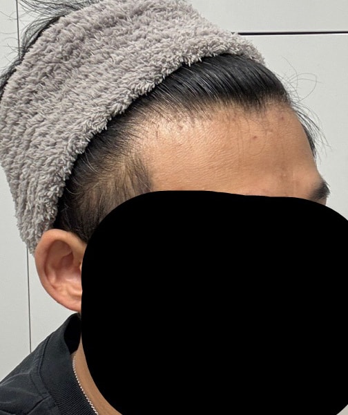 다나 모발이식 1400모낭 6개월 모발이식은 투자입니다