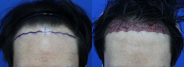 비절개 3200모 직후 사진이랑 해서 올려봐요