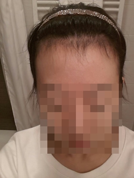 3100モダナヘアライン矯正のレビューです~