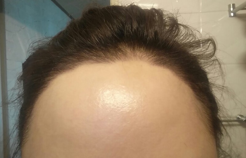 It's been two days since I got my hairline done