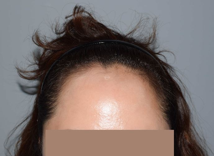 Leave a review of the hairline correction