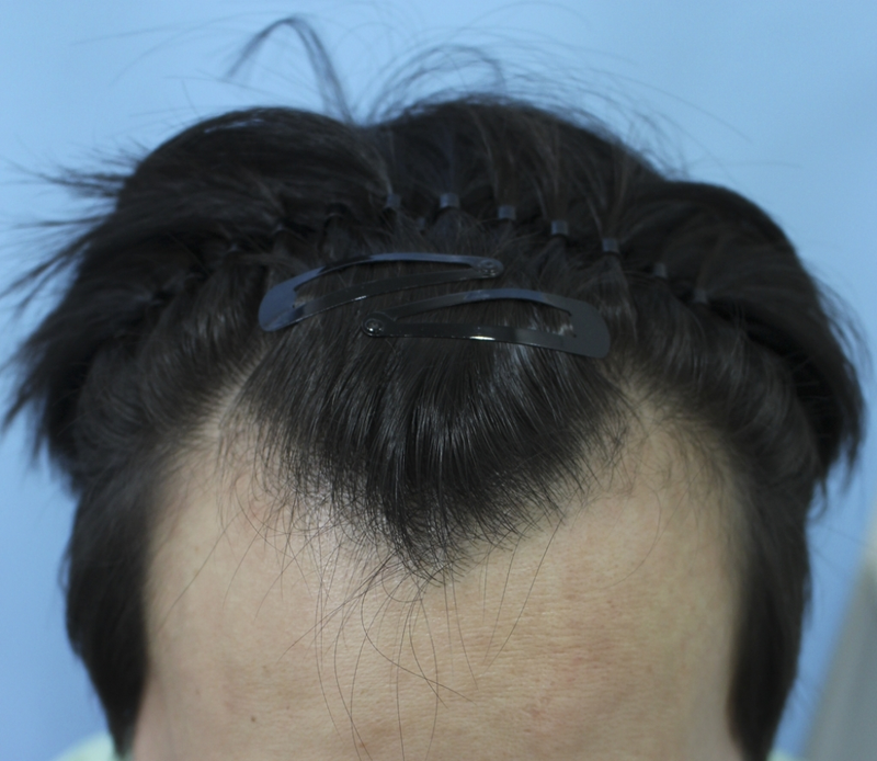 M-shaped hair loss incision 2,000mo, 6 months review