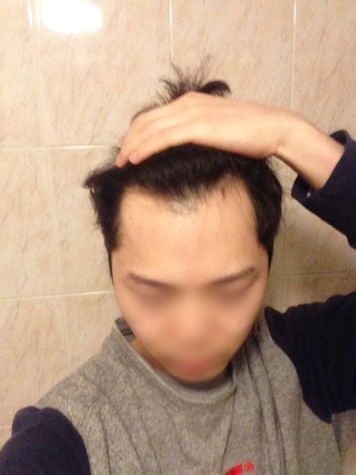 02.노민준_수술전.jpeg