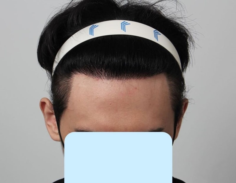 부산 포헤어 1년 경과종료 2000모낭 비절개모발이식 후기