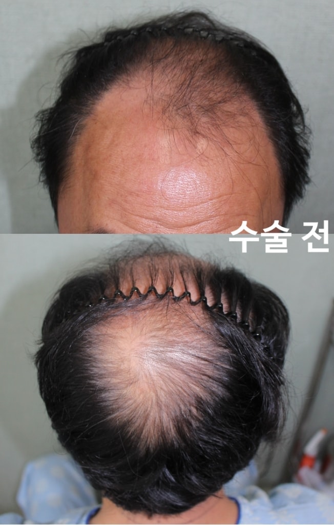 수술전.jpg