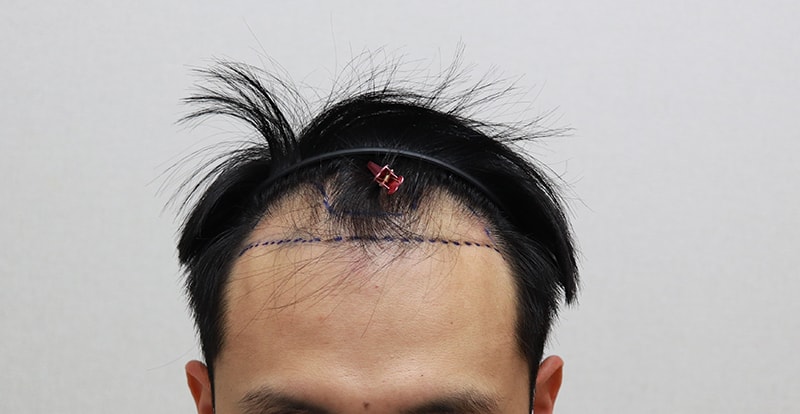MOPLUS 4000 MO 5个月后期