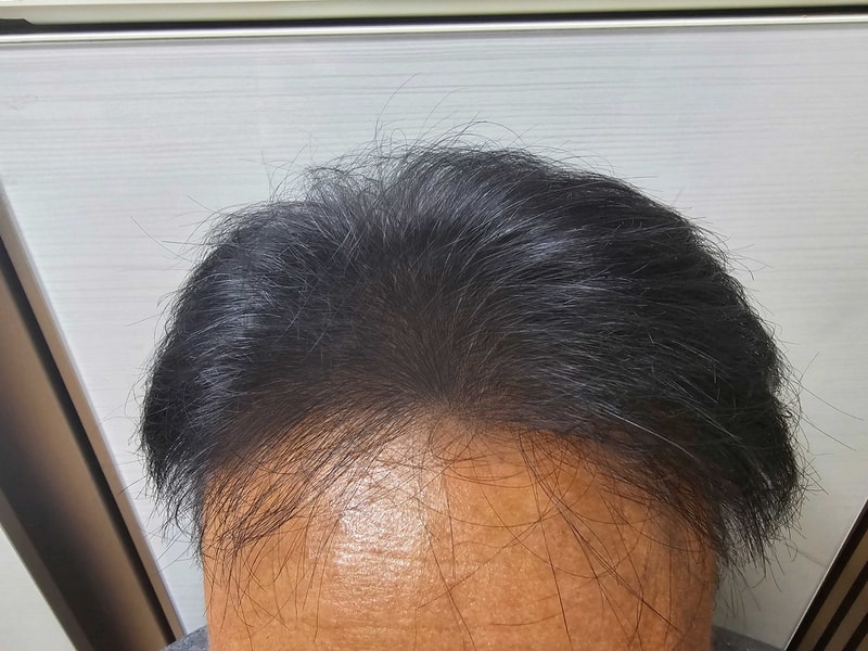 Dana Plastic Surgery in the 28th month of mass hair transplantation with 6400 hairs. If you don't have hair, I recommend a beard!