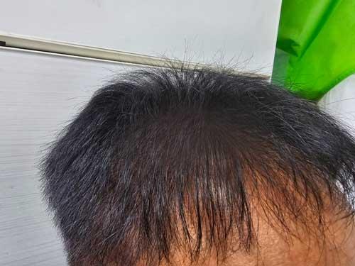 다나성형외과 3200모낭 대량모발이식 20개월되었습니다.