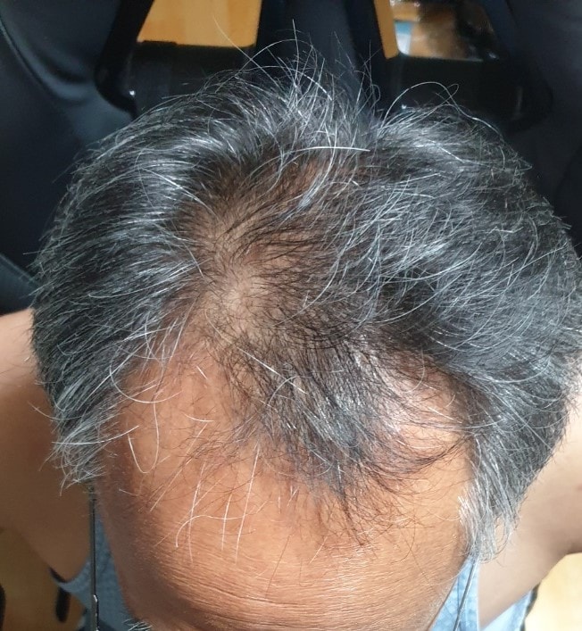 다나성형외과 3200모낭 비절개 17달차입니다