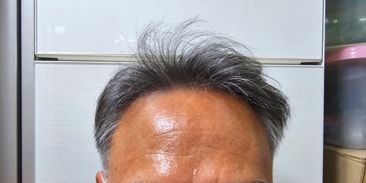 비절개모발이식 2년이네요 다나성형외과에 감사.