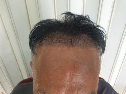 수술10일.jpg