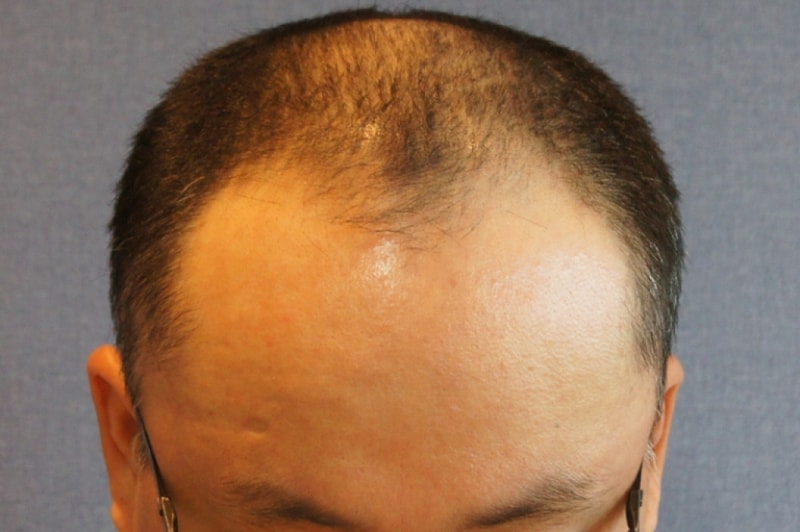 上传2000毛囊手术2个月后的照片