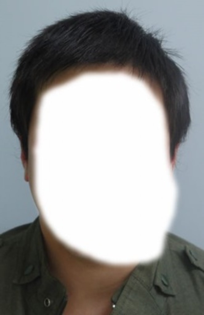 [ATAS] 非接缝 2千毛囊 3个月后期