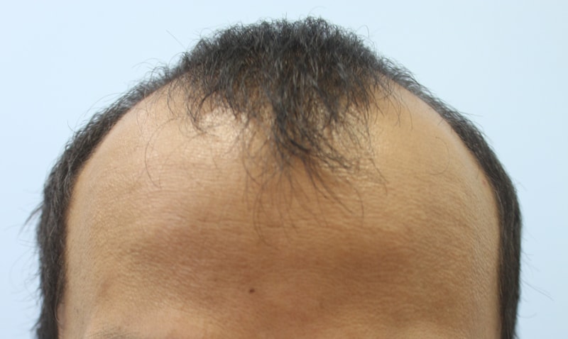 M-shaped incision 3700 hair_right after implantation