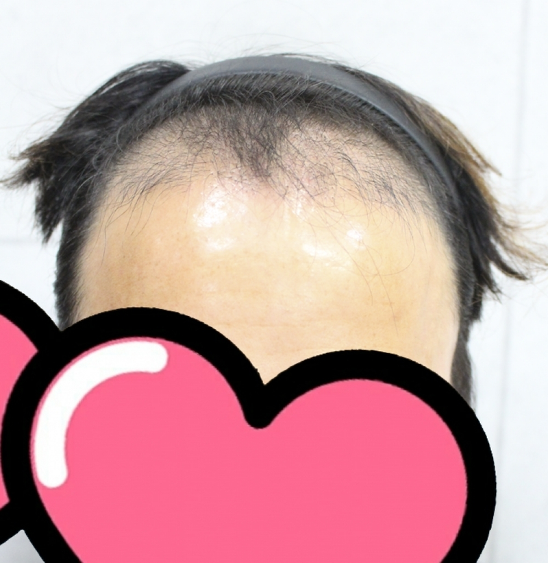 절개 3000모 3개월차 입니다 봐주세요~