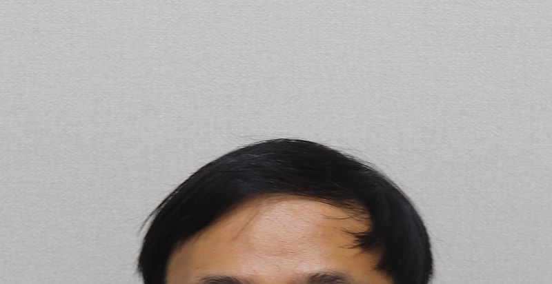 7 수술전 앞머리 평소 스타일.JPG
