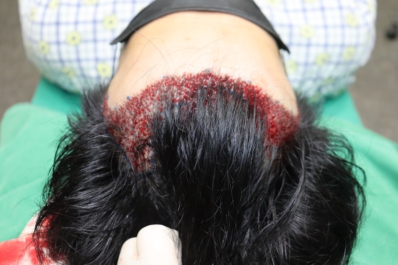 수술 후2.jpg