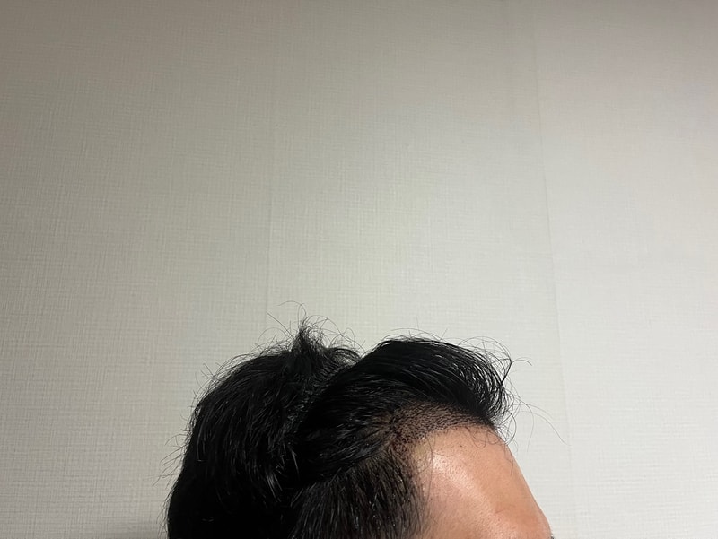 수술 6일차 2.jpg