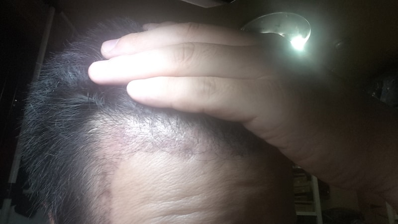 75 days (two and a half months) 1200 hair follicles