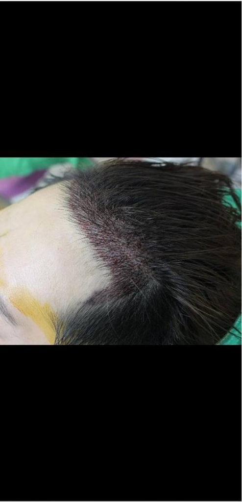 Hannaive 3000 hair incision