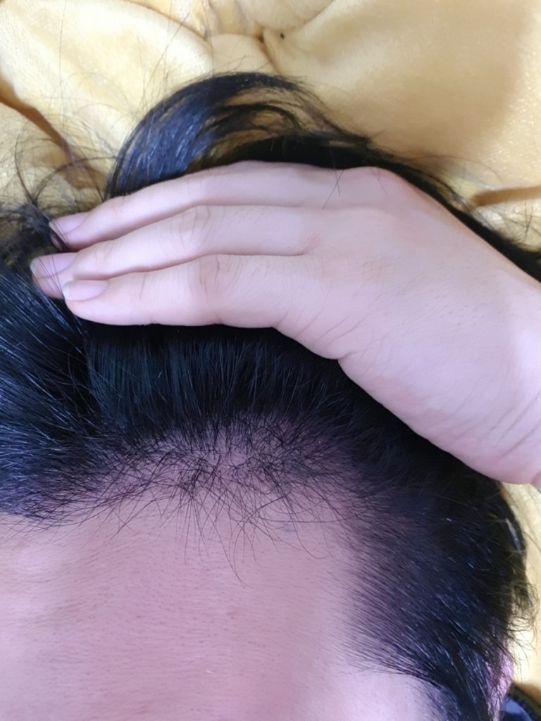 It's the 5th month of New Hair incision.
