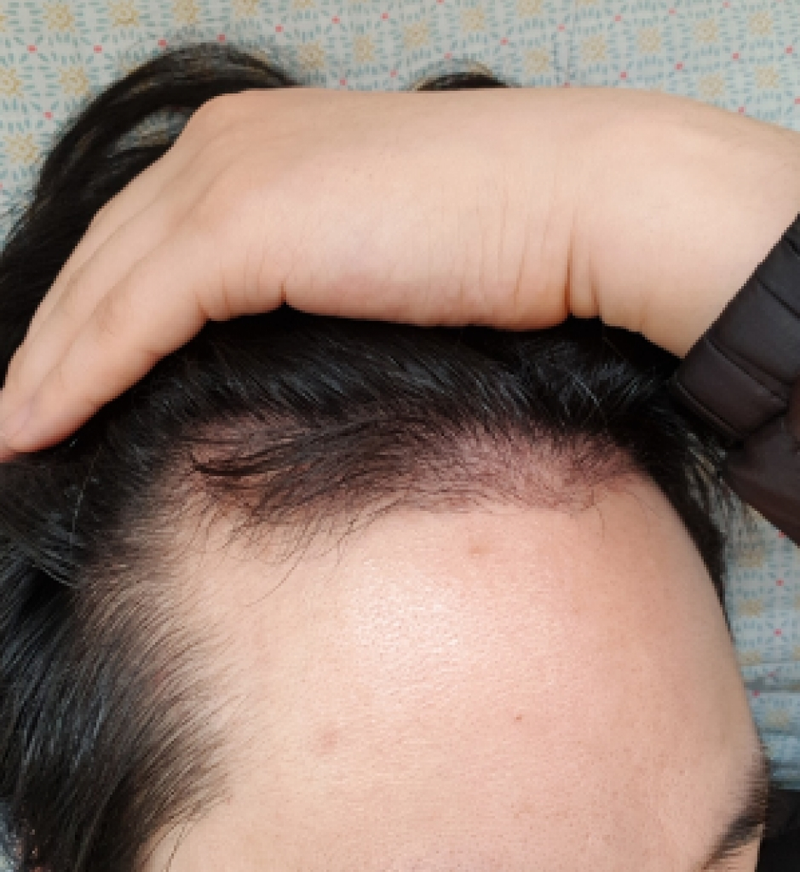 I'm four months into my incision
