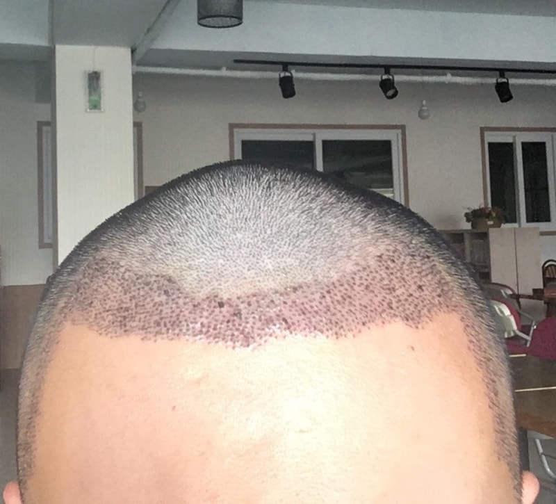 Please evaluate on the 7th day of the M-shaped 1600 hair follicle shaving operation.
