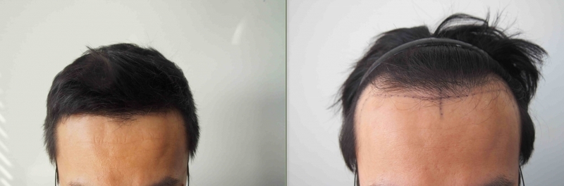 Parental 3,000 hair transplantation stormy hair 4 months later