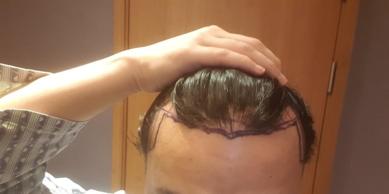 1年1个月后期.. 还要再种几毛呢？