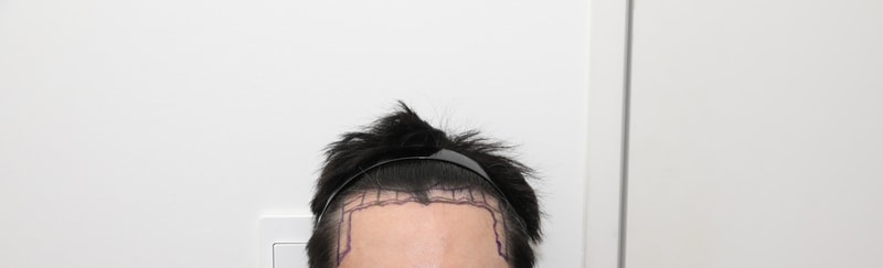 New Hair (Seoul) Emzaima Non-Cutting Hair Transplantation Day 7