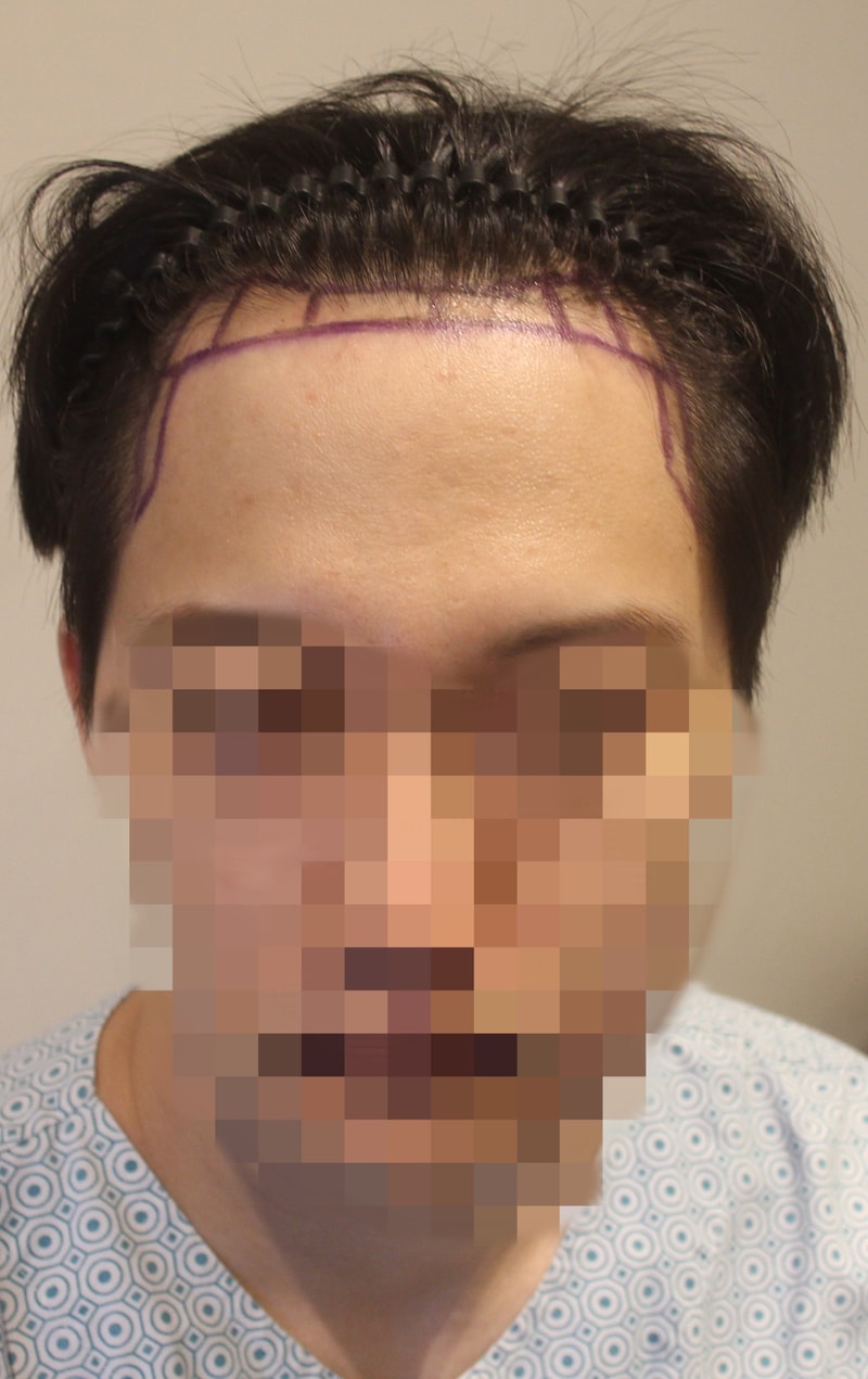 New Hair Seoul Branch's Non-Sectionary Hair Transplantation 1100 Hair follicles in 9 Months Late Review