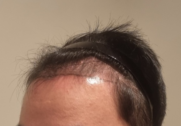 탈모_치료전2.png