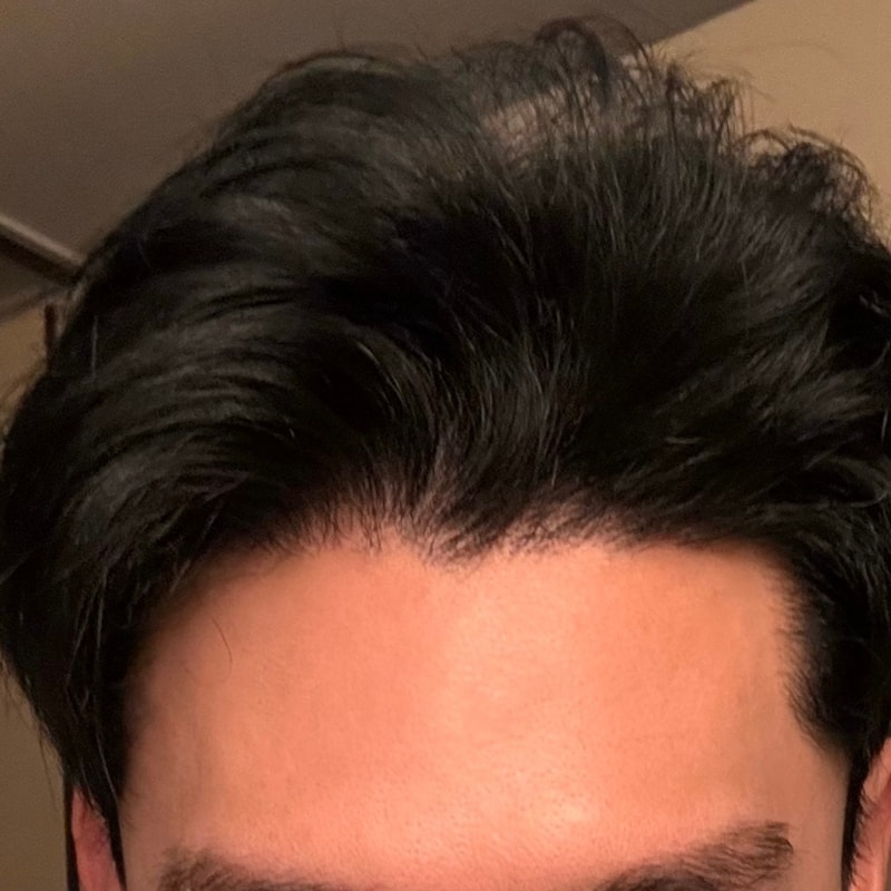 New Hair 首尔店 非切开毛发移植 1549 毛囊 9个月后期