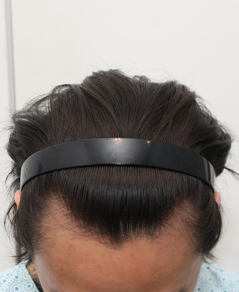 New Hair (Seoul) Non-Cutting 1500 Hair follicles (3000 Mo) Day 5 Review