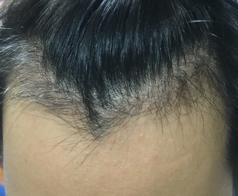 비절개 무삭발 67일차