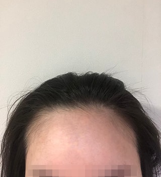 New Hair Hairline 6 months review!