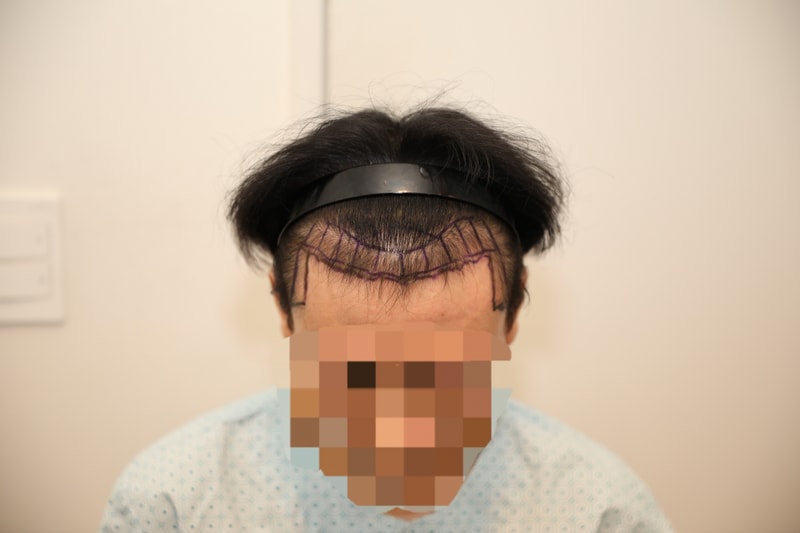 New Hair Hair Transplantation Hospital Day 7 Non-Cutting Hair Transplantation Review! I got 1,800 hair follicles