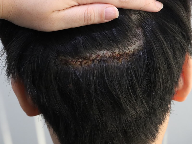 수술 다음날 절개부위.JPG