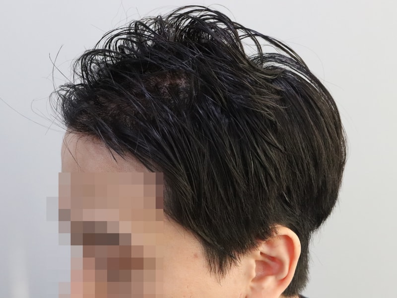 수술 다음날 측면.JPG