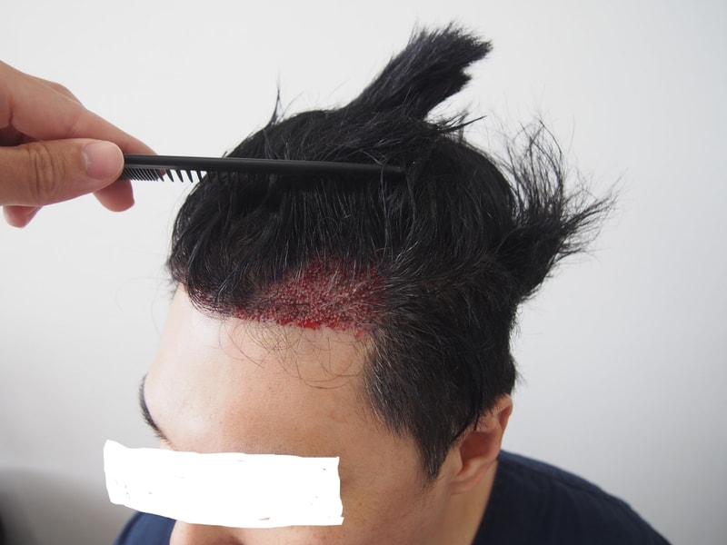 InkedP6070101_수술측면2.jpg