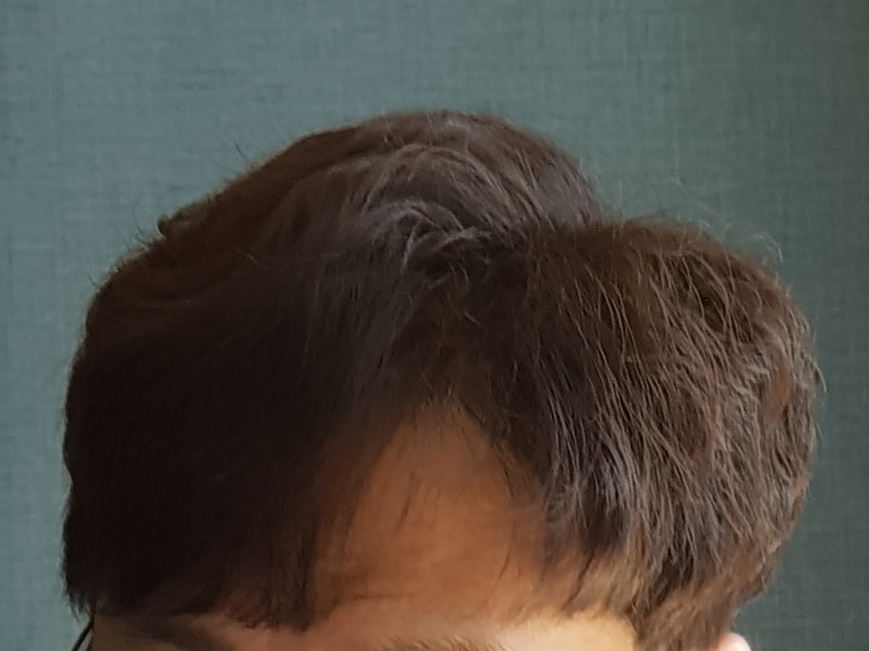 6th year photo of transplant