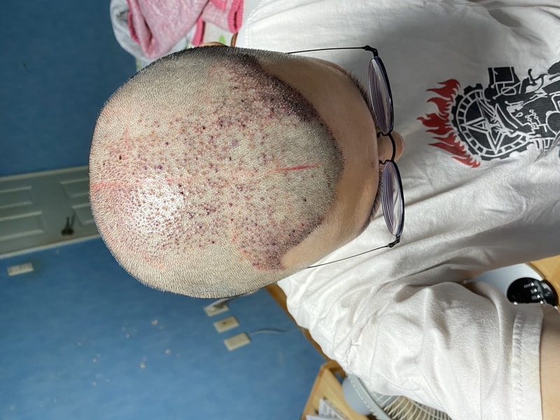 Day 2 of surgery in Busan forehair!