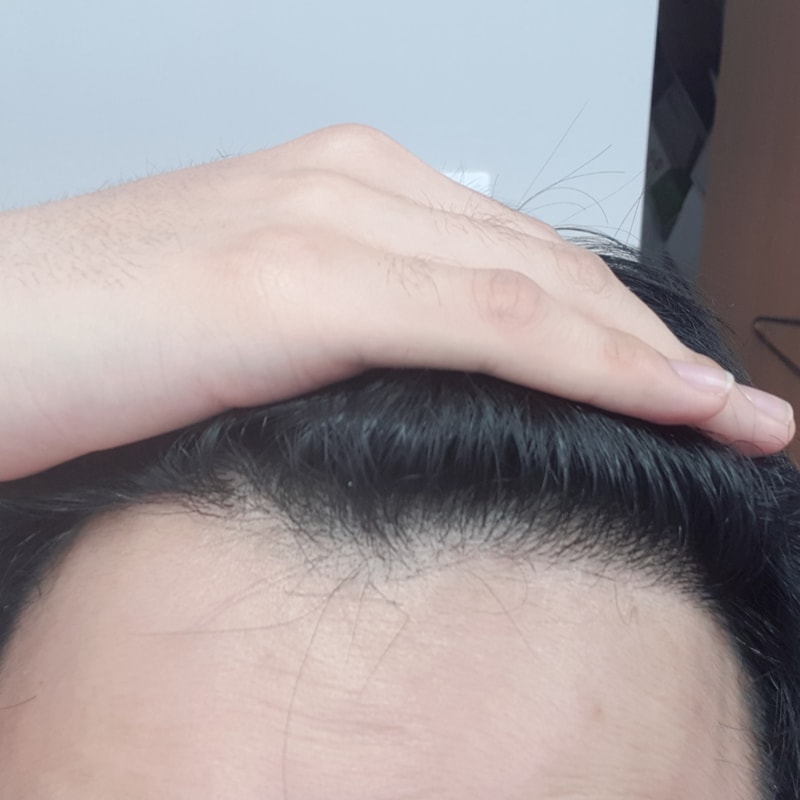 术后8个月后期