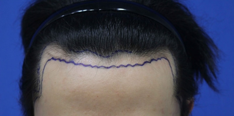 Look at the 2200-mo surgery