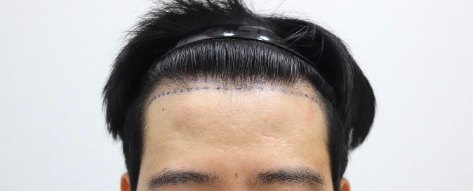 37th day review of M-shaped bangs transplant